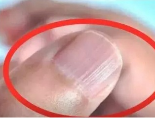 亚洲夜色撩人国产AV廠家分析手指甲有豎紋的根本原因 亚洲夜色撩人国产AV廠家分析手指甲有豎紋的根本原因